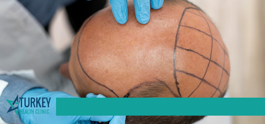 DHI Hair Transplant
