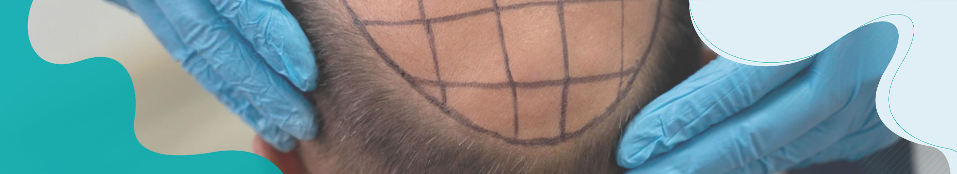 DHI Hair Transplant