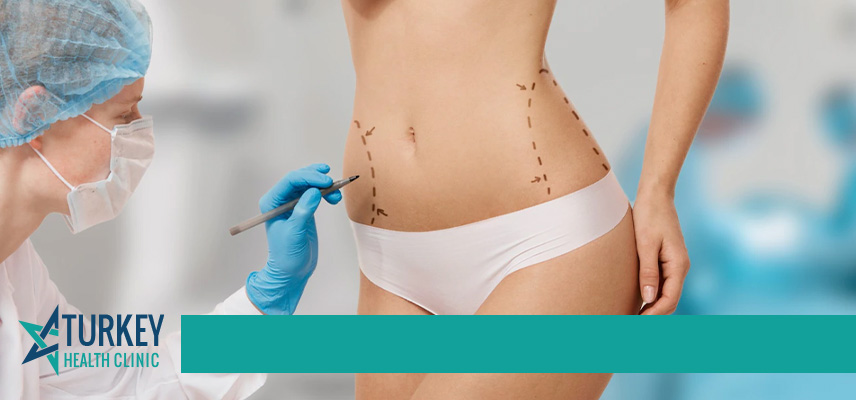 Tummy Tuck